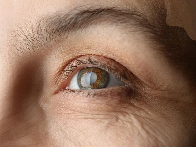 Katarakt Nedir? Belirtileri ve Tedavisi Nedir?